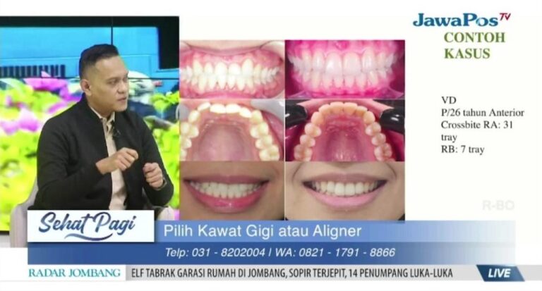 Mau Gigi Rapi Tanpa Behel? Kenalan Yuk dengan Clear Aligner!